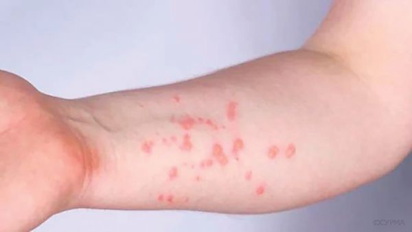 Мавп’яча віспа. Реальна загроза чи продовження політики?